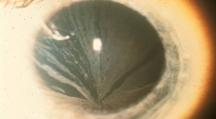 Cornea Opacity