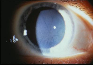 Cornea Opacity