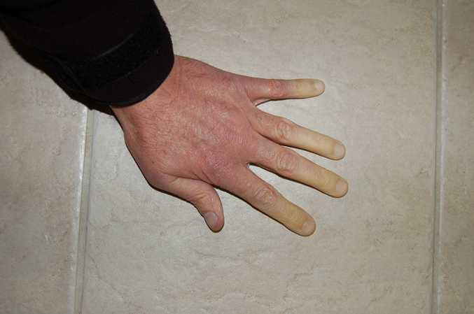 Raynaud's Phenomenom
